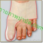 บำบัดนิ้วเท้าคต แบบสวมใส่รองเท้าได้